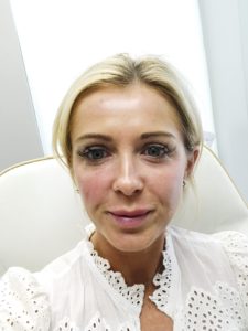 Top US beauty blogger, Leslie Nicole Langan, shares all the info you need to know about cosmetic facial procedures with Gilpin Facial Plastics in Nashville: lip fillers before and After