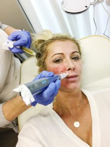 Top US beauty blogger, Leslie Nicole Langan, shares all the info you need to know about cosmetic facial procedures with Gilpin Facial Plastics in Nashville: vampire facial before and After